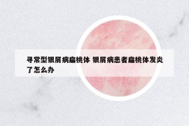 尋常型銀屑病扁桃體 銀屑病患者扁桃體發(fā)炎了怎么辦