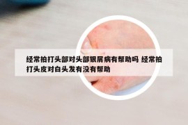 經常拍打頭部對頭部銀屑病有幫助嗎 經常拍打頭皮對白頭發(fā)有沒有幫助