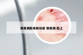 銀屑病臉有蟻動(dòng)感 銀屑病 臉上
