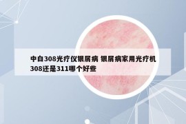 中白308光療儀銀屑病 銀屑病家用光療機(jī)308還是311哪個(gè)好些