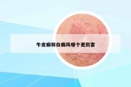 牛皮癬和白癜風(fēng)哪個(gè)更厲害