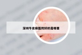 深圳牛皮癬醫(yī)院好的是哪里