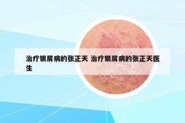 治療銀屑病的張正天 治療銀屑病的張正天醫(yī)生