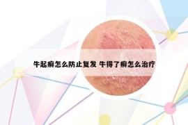牛起癬怎么防止復(fù)發(fā) 牛得了癬怎么治療