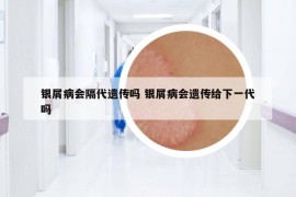 銀屑病會隔代遺傳嗎 銀屑病會遺傳給下一代嗎