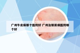 廣州牛皮癬那個(gè)醫(yī)院好 廣州治銀屑病醫(yī)院哪個(gè)好