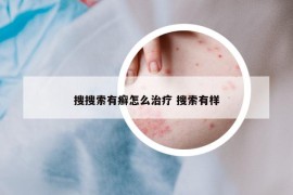 搜搜索有癬怎么治療 搜索有樣