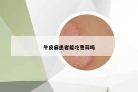 牛皮癬患者能吃蔥蒜嗎