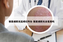銀屑病照光后疼紅咋辦 銀屑病照光會變黑嗎