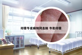 印章牛皮癬如何去除 牛形印章