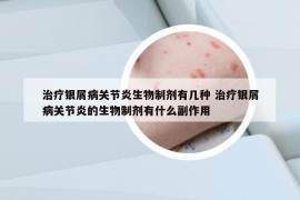 治療銀屑病關(guān)節(jié)炎生物制劑有幾種 治療銀屑病關(guān)節(jié)炎的生物制劑有什么副作用