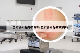乙肝會(huì)引起牛皮癬嗎 乙肝會(huì)引起皮膚病嗎