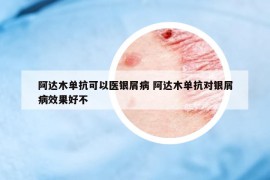 阿達(dá)木單抗可以醫(yī)銀屑病 阿達(dá)木單抗對銀屑病效果好不