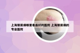 上海銀屑病哪里看最好的醫(yī)院 上海銀屑病的專業(yè)醫(yī)院