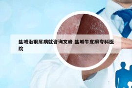 鹽城治銀屑病就咨詢文峰 鹽城牛皮癬?？漆t(yī)院