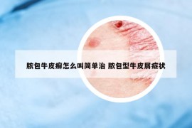 膿包牛皮癬怎么叫簡(jiǎn)單治 膿包型牛皮屑癥狀