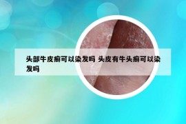 頭部牛皮癬可以染發(fā)嗎 頭皮有牛頭癬可以染發(fā)嗎