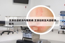 王清任逐瘀湯與銀屑病 王清任的五大逐瘀湯配方