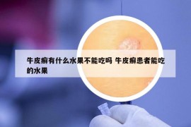 牛皮癬有什么水果不能吃嗎 牛皮癬患者能吃的水果