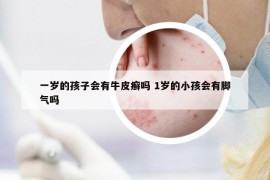 一歲的孩子會(huì)有牛皮癬嗎 1歲的小孩會(huì)有腳氣嗎