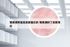 銀屑病恢復(fù)后皮膚是紅的 銀屑病好了皮膚發(fā)紅