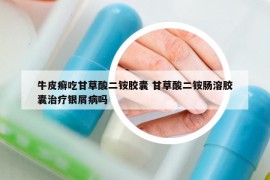 牛皮癬吃甘草酸二銨膠囊 甘草酸二銨腸溶膠囊治療銀屑病嗎