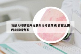 首都兒科研究所皮膚科治療銀屑病 首都兒研所皮膚科專家