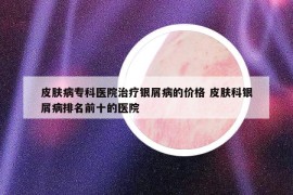 皮膚病?？漆t(yī)院治療銀屑病的價格 皮膚科銀屑病排名前十的醫(yī)院