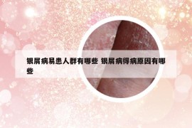 銀屑病易患人群有哪些 銀屑病得病原因有哪些