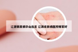 遼源銀屑病華山選定 遼源皮膚病醫(yī)院哪家好