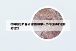 柏樹枝蔥白花椒治銀屑病嗎 柏樹枝熬水泡腳的功效