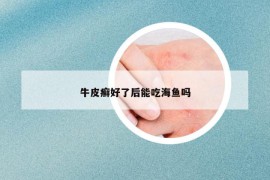 牛皮癬好了后能吃海魚嗎