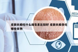 皮膚長癬吃什么維生素比較好 皮膚長癬多吃哪些食物