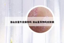 淮山會是牛皮癬樣嗎 淮山是發(fā)物嗎皮膚病