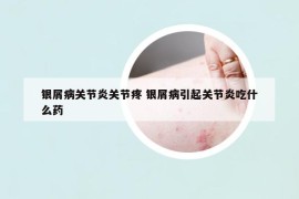 銀屑病關(guān)節(jié)炎關(guān)節(jié)疼 銀屑病引起關(guān)節(jié)炎吃什么藥