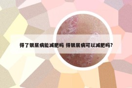 得了銀屑病能減肥嗎 得銀屑病可以減肥嗎?