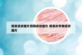 銀屑癥狀圖片初期癥狀圖片 銀屑的早期癥狀圖片