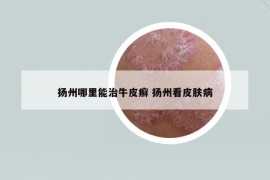 揚(yáng)州哪里能治牛皮癬 揚(yáng)州看皮膚病