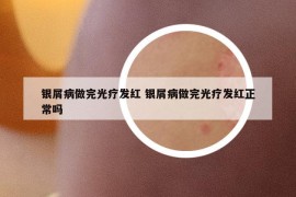 銀屑病做完光療發(fā)紅 銀屑病做完光療發(fā)紅正常嗎