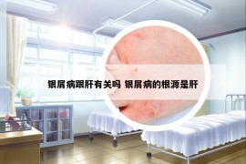 銀屑病跟肝有關(guān)嗎 銀屑病的根源是肝