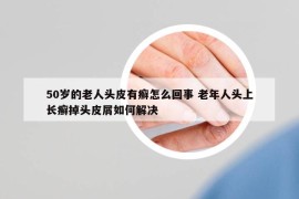 50歲的老人頭皮有癬怎么回事 老年人頭上長(zhǎng)癬掉頭皮屑如何解決
