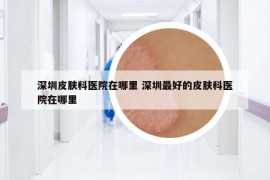 深圳皮膚科醫(yī)院在哪里 深圳最好的皮膚科醫(yī)院在哪里