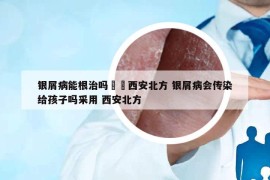 銀屑病能根治嗎來選西安北方 銀屑病會(huì)傳染給孩子嗎采用 西安北方