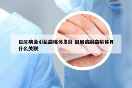 銀屑病會引起扁桃體發(fā)炎 銀屑病跟扁桃體有什么關(guān)聯(lián)