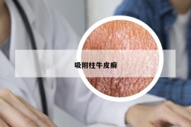 吸附柱牛皮癬
