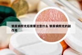 銀屑病照光后需要注意什么 銀屑病照光的副作用