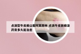 點滴型牛皮癬口服阿莫西林 點滴牛皮膚癬涂藥膏多久能治愈