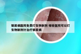 銀屑病醫(yī)院免費(fèi)打生物制劑 哪些醫(yī)院可以打生物制劑針治療銀屑病