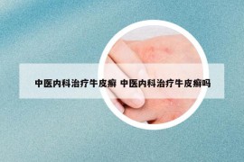 中醫(yī)內(nèi)科治療牛皮癬 中醫(yī)內(nèi)科治療牛皮癬嗎