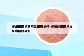 鄭州國醫(yī)堂醫(yī)院治銀屑病嗎 鄭州市國醫(yī)堂皮膚病醫(yī)院真假